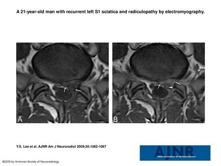 A 21-year-old man with recurrent left S1 sciatica and radiculopathy by electromyography. A 21-year-old man with recurrent left S1 sciatica and radiculopathy.