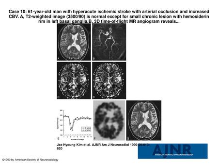 Case 10: 61-year-old man with hyperacute ischemic stroke with arterial occlusion and increased CBV. A, T2-weighted image (3500/90) is normal except for.