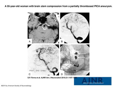 A 55-year-old woman with brain stem compression from a partially thrombosed PICA aneurysm. A 55-year-old woman with brain stem compression from a partially.
