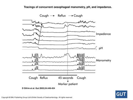 Tracings of concurrent oesophageal manometry, pH, and impedance.