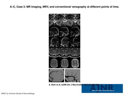 A–C, Case 3: MR imaging, MRV, and conventional venography at different points of time. A–C, Case 3: MR imaging, MRV, and conventional venography at different.