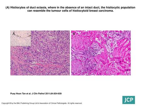 (A) Histiocytes of duct ectasia, where in the absence of an intact duct, the histiocytic population can resemble the tumour cells of histiocytoid breast.