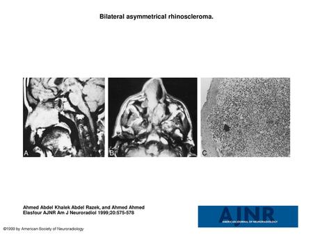 Bilateral asymmetrical rhinoscleroma.