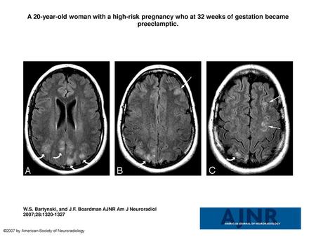 A 20-year-old woman with a high-risk pregnancy who at 32 weeks of gestation became preeclamptic. A 20-year-old woman with a high-risk pregnancy who at.