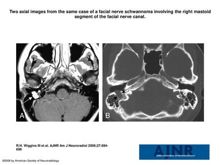 Two axial images from the same case of a facial nerve schwannoma involving the right mastoid segment of the facial nerve canal. Two axial images from the.