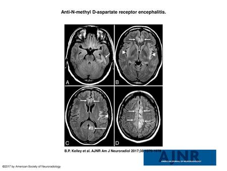 Anti-N-methyl D-aspartate receptor encephalitis.