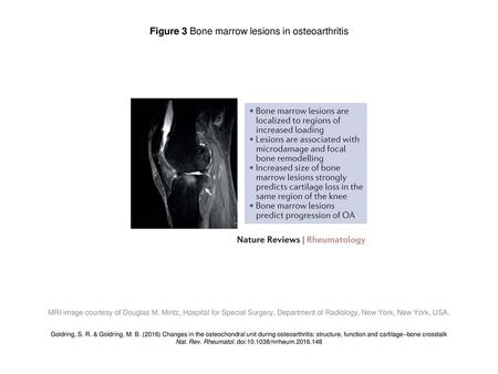 Figure 3 Bone marrow lesions in osteoarthritis