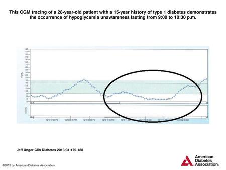 This CGM tracing of a 28-year-old patient with a 15-year history of type 1 diabetes demonstrates the occurrence of hypoglycemia unawareness lasting from.