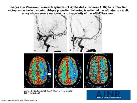 Images in a 53-year-old man with episodes of right-sided numbness