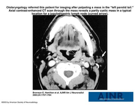 Otolaryngology referred this patient for imaging after palpating a mass in the “left parotid tail.” Axial contrast-enhanced CT scan through the mass reveals.
