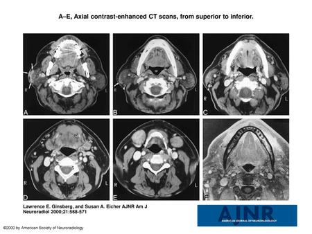A–E, Axial contrast-enhanced CT scans, from superior to inferior.