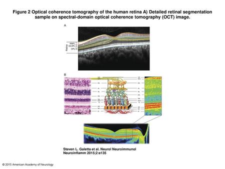 Figure 2 Optical coherence tomography of the human retina A) Detailed retinal segmentation sample on spectral-domain optical coherence tomography (OCT)