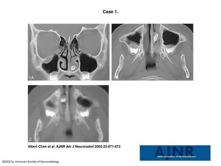 Case 1. Case 1. CT scans in an 8-year-old boy with an ectopic tooth in the left nasal cavity.A, Coronal scan obtained with a bone window setting of 600-HU.