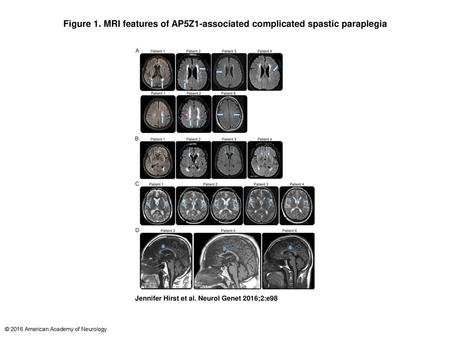 Figure 1. MRI features of AP5Z1-associated complicated spastic paraplegia MRI features of AP5Z1-associated complicated spastic paraplegia (A) Periventricular.