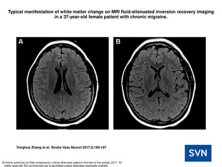 Typical manifestation of white matter change on MRI fluid-attenuated inversion recovery imaging in a 37-year-old female patient with chronic migraine.