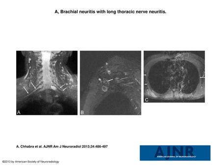 A, Brachial neuritis with long thoracic nerve neuritis.