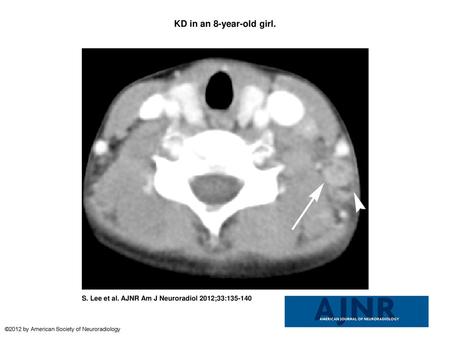 KD in an 8-year-old girl. KD in an 8-year-old girl. Transverse CT image shows a lymph node (arrow) containing multiple necrotic foci in the peripheral.