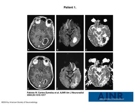 Patient 1. Patient 1. A 40-year-old man with mild ataxia and homonymous hemianopia. CRP level was initially 0.5 mg/dL and did not change in the clinical.