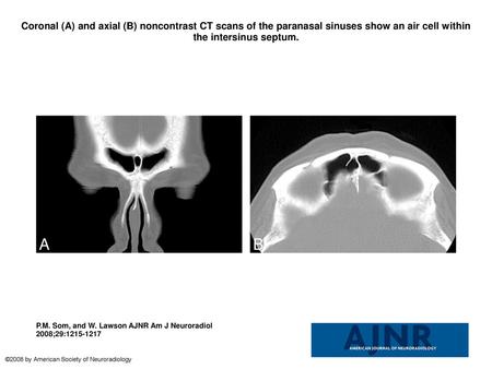 Coronal (A) and axial (B) noncontrast CT scans of the paranasal sinuses show an air cell within the intersinus septum. Coronal (A) and axial (B) noncontrast.