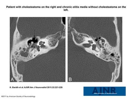 Patient with cholesteatoma on the right and chronic otitis media without cholesteatoma on the left. Patient with cholesteatoma on the right and chronic.