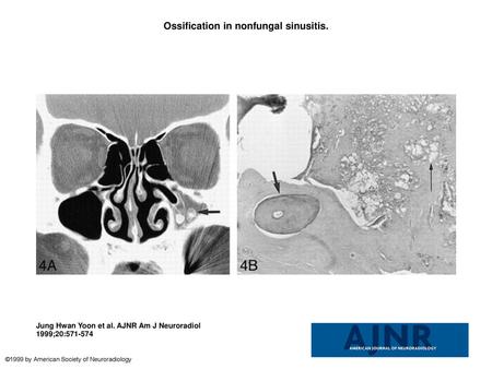 Ossification in nonfungal sinusitis.