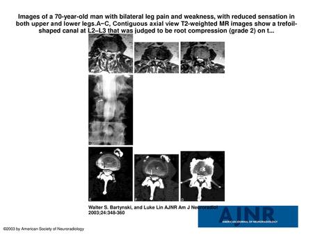 Images of a 70-year-old man with bilateral leg pain and weakness, with reduced sensation in both upper and lower legs.A−C, Contiguous axial view T2-weighted.
