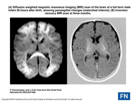  (A) Diffusion weighted magnetic resonance imaging (MRI) scan of the brain of a full term male infant 56 hours after birth, showing parasagittal changes.