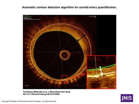 Automatic contour detection algorithm for carotid artery quantification. Automatic contour detection algorithm for carotid artery quantification. The endoluminal.
