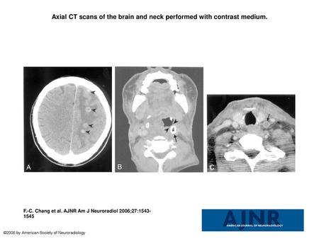 Axial CT scans of the brain and neck performed with contrast medium.