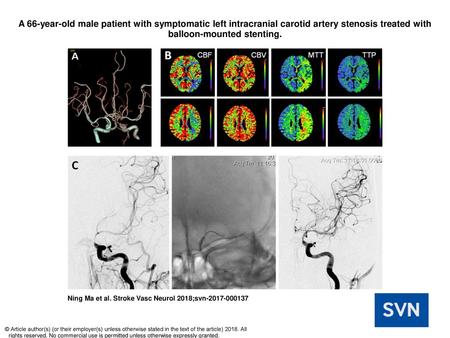 A 66-year-old male patient with symptomatic left intracranial carotid artery stenosis treated with balloon-mounted stenting. A 66-year-old male patient.