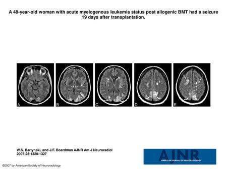 A 48-year-old woman with acute myelogenous leukemia status post allogenic BMT had a seizure 19 days after transplantation. A 48-year-old woman with acute.
