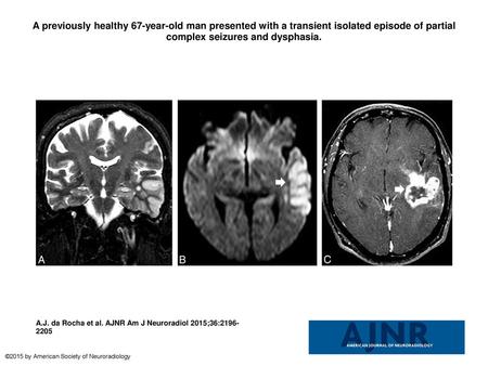 A previously healthy 67-year-old man presented with a transient isolated episode of partial complex seizures and dysphasia. A previously healthy 67-year-old.