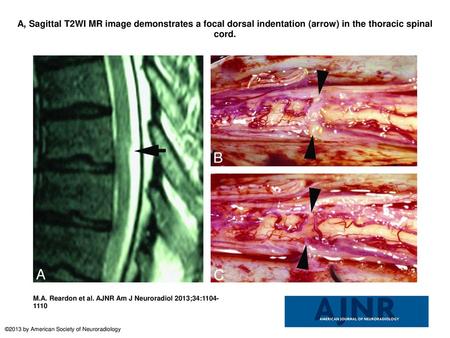 A, Sagittal T2WI MR image demonstrates a focal dorsal indentation (arrow) in the thoracic spinal cord. A, Sagittal T2WI MR image demonstrates a focal dorsal.