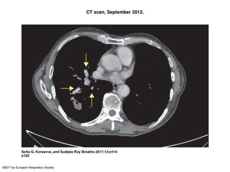 CT scan, September 2012. CT scan, September 2012. Several new lung masses can be seen. There is a cavitating soft tissue mass measuring 2.5×1.9 cm within.