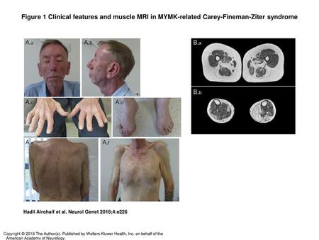 Figure 1 Clinical features and muscle MRI in MYMK-related Carey-Fineman-Ziter syndrome Clinical features and muscle MRI in MYMK-related Carey-Fineman-Ziter.