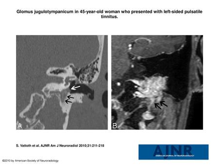 Glomus jugulotympanicum in 45-year-old woman who presented with left-sided pulsatile tinnitus. Glomus jugulotympanicum in 45-year-old woman who presented.