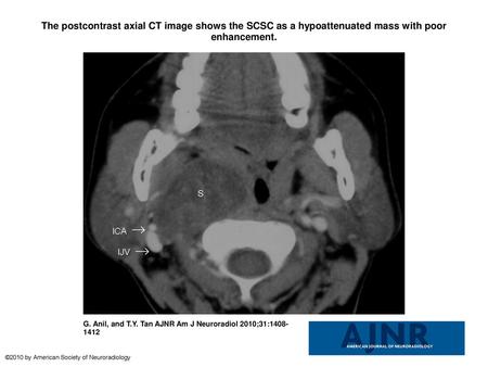 The postcontrast axial CT image shows the SCSC as a hypoattenuated mass with poor enhancement. The postcontrast axial CT image shows the SCSC as a hypoattenuated.