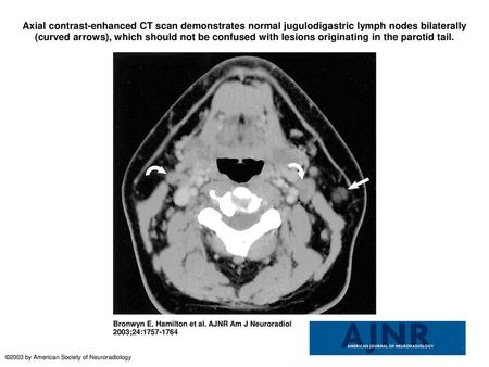 Axial contrast-enhanced CT scan demonstrates normal jugulodigastric lymph nodes bilaterally (curved arrows), which should not be confused with lesions.