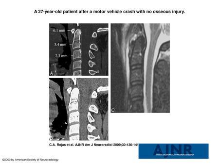 A 27-year-old patient after a motor vehicle crash with no osseous injury. A 27-year-old patient after a motor vehicle crash with no osseous injury. A,