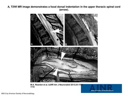 A, T2WI MR image demonstrates a focal dorsal indentation in the upper thoracic spinal cord (arrow). A, T2WI MR image demonstrates a focal dorsal indentation.