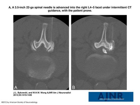 A, A 3.5-inch 22-ga spinal needle is advanced into the right L4–5 facet under intermittent CT guidance, with the patient prone. A, A 3.5-inch 22-ga spinal.