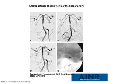 Anteroposterior oblique views of the basilar artery.