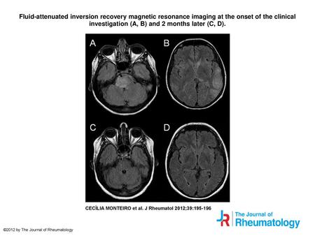 Fluid-attenuated inversion recovery magnetic resonance imaging at the onset of the clinical investigation (A, B) and 2 months later (C, D). Fluid-attenuated.