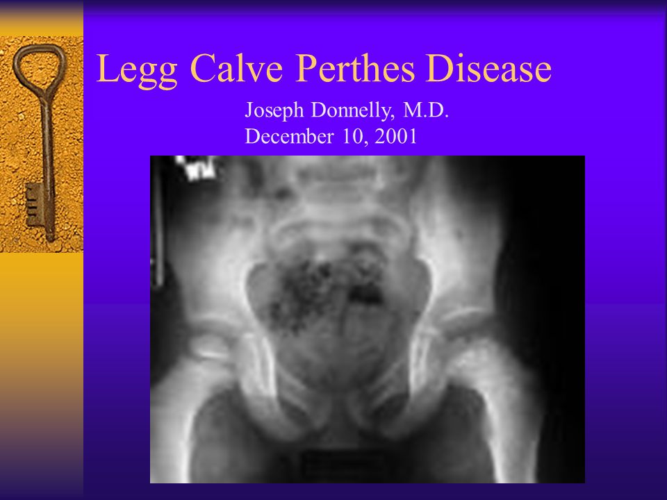Legg Calve Perthes Disease - ppt download
