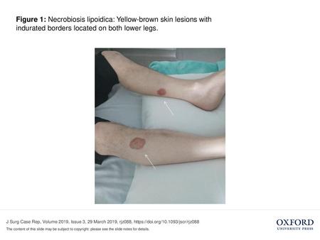 Figure 1: Necrobiosis lipoidica: Yellow-brown skin lesions with indurated borders located on both lower legs. Figure 1: Necrobiosis lipoidica: Yellow-brown.