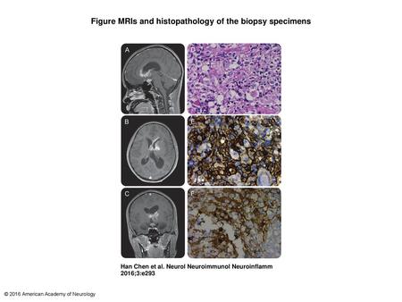 Figure MRIs and histopathology of the biopsy specimens