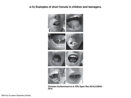 a–h) Examples of short frenula in children and teenagers.