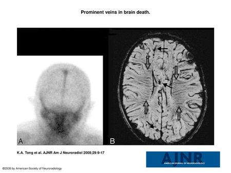 Prominent veins in brain death.