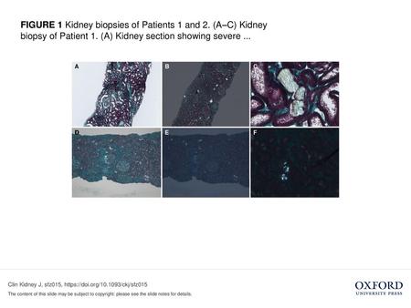 FIGURE 1 Kidney biopsies of Patients 1 and 2