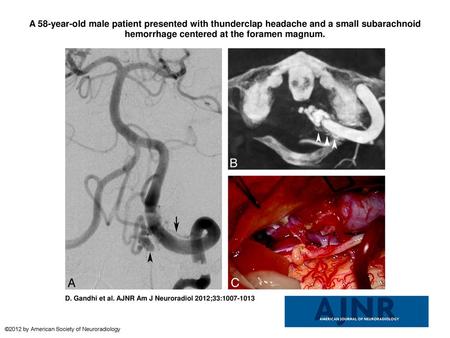 A 58-year-old male patient presented with thunderclap headache and a small subarachnoid hemorrhage centered at the foramen magnum. A 58-year-old male patient.